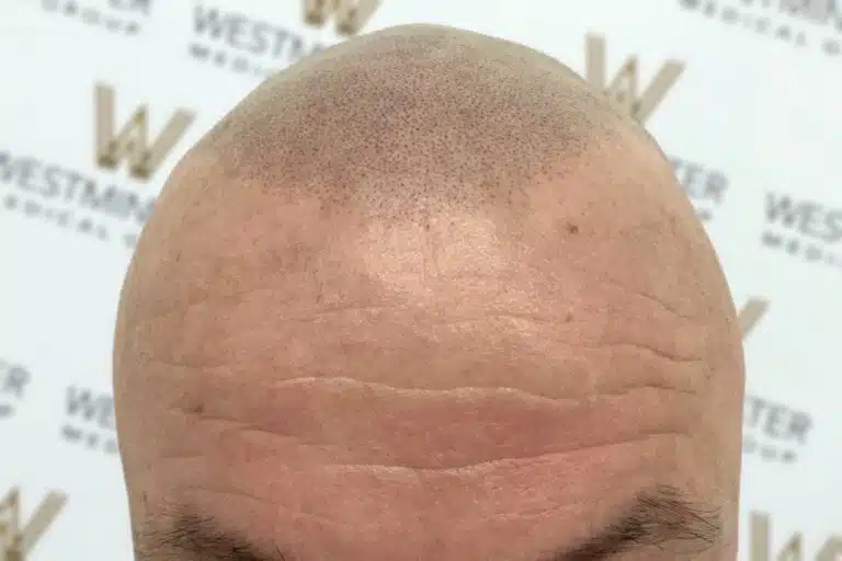 Close-up of a bald head showing detail of hair implant regions, skin texture, and slight forehead wrinkles, against a patterned background with logos.