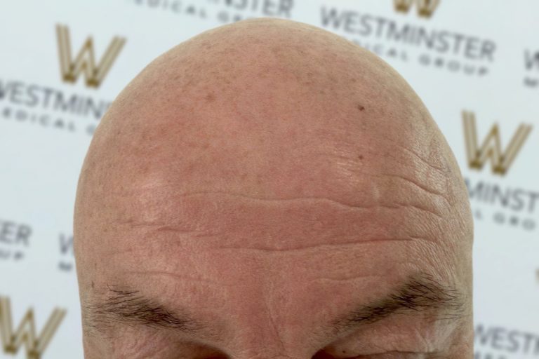 Close-up of a person's forehead and eyebrows with male pattern baldness, showing detailed skin texture against a background featuring the Westminster logo.