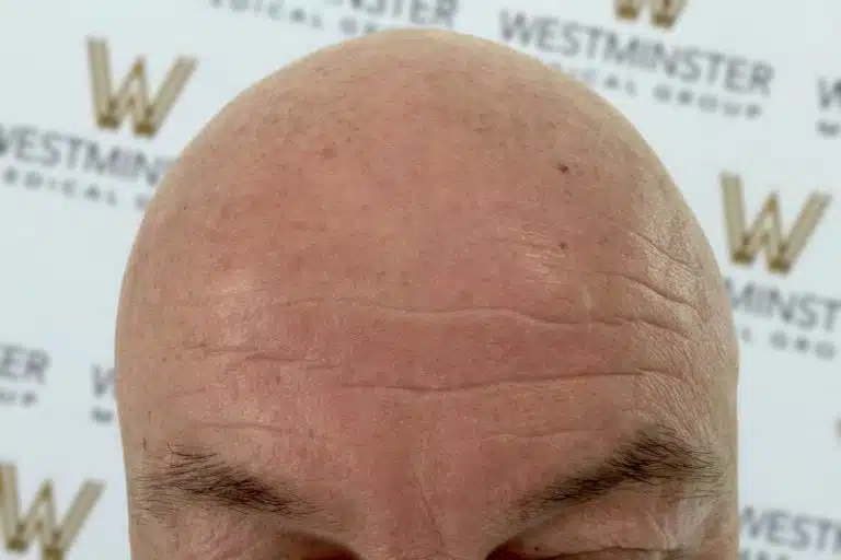 Close-up of a person's forehead and eyebrows with male pattern baldness, showing detailed skin texture against a background featuring the Westminster logo.