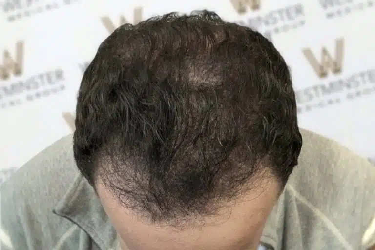Top-down view of a person’s head showing male pattern baldness and thinning hair on the crown, with a logo-filled background.
