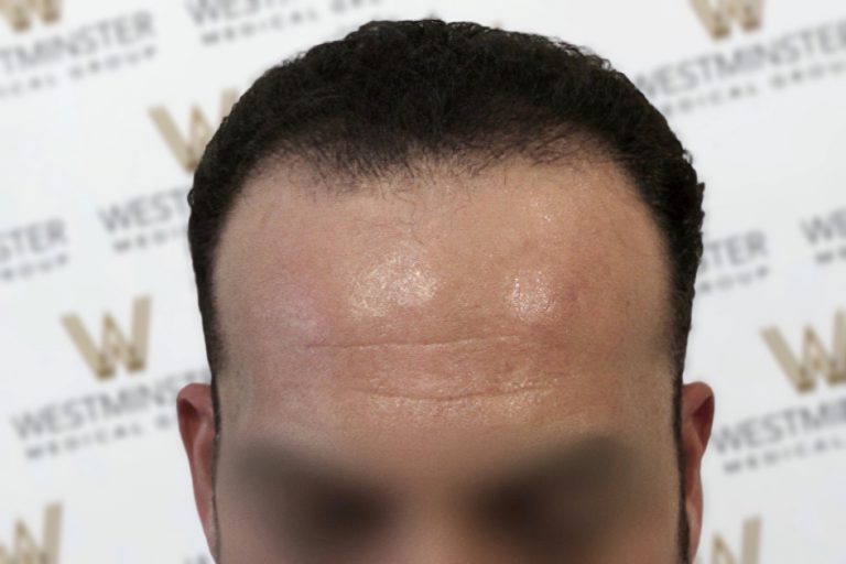 Close-up of a man's forehead showing detail of hair regrowth and skin texture against a blurred background with a repeating logo pattern. The face is blurred for privacy.
