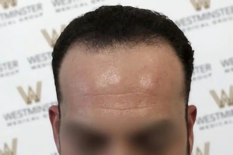 Close-up of a man's forehead showing detail of hair regrowth and skin texture against a blurred background with a repeating logo pattern. The face is blurred for privacy.
