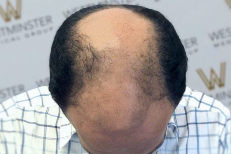 Top view of a man's head showing advanced hair thinning with some remaining hair on the sides and back against a blurred background with logos, indicative of potential hair replacement needs.