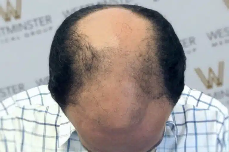 Top view of a man's head showing advanced hair thinning with some remaining hair on the sides and back against a blurred background with logos, indicative of potential hair replacement needs.