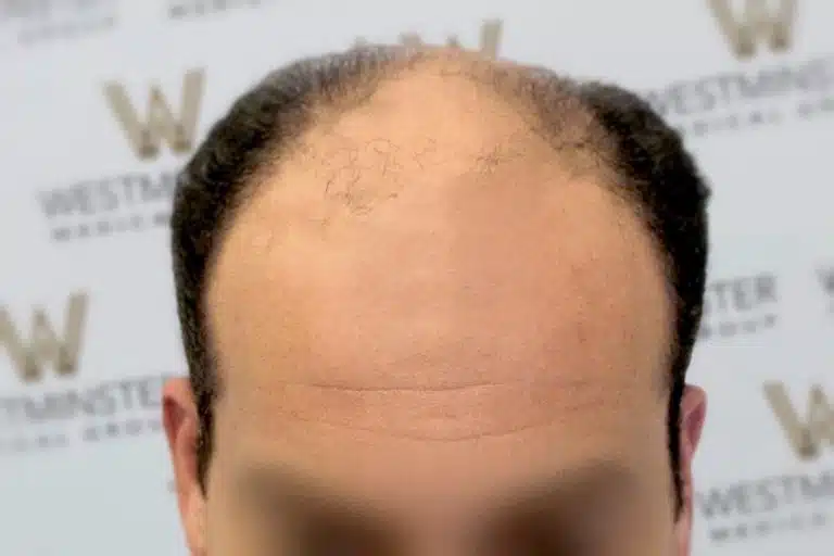 Close-up of a person's forehead showing the early stages of female hair loss, with a blurred background featuring a logo.