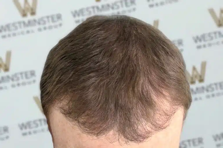 Top view of a person's head showing brown hair with signs of thinning and a receding hairline, with a backdrop featuring the "Westminster" logo repeated, indicative of female hair loss.