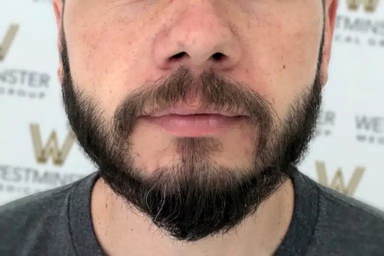 Close-up of a man's lower face showing his nose down to his chin, featuring a well-groomed beard and mustache against a background with the WWE logo. The image subtly emphasizes solutions for