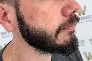 Close-up of a man's lower face showing his beard, hair implant, and the profile of his cheek and ear, with a blurred logo of "webinstinct" in the background.