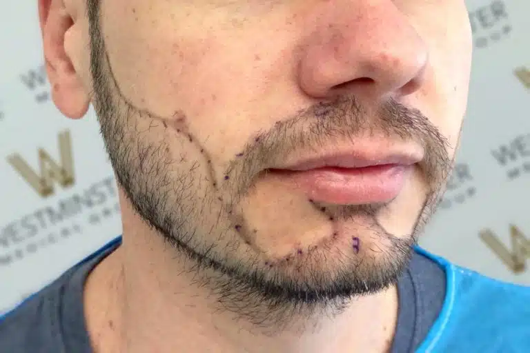 Close-up of a man's lower face showing a beard, male pattern baldness, and stitched scars on his cheek and neck.
