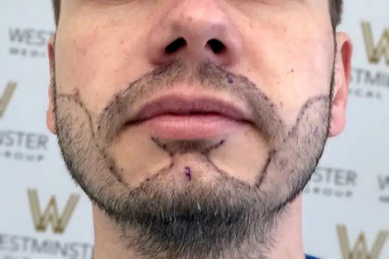 Close-up of a young man's lower face showing a beard and a purple surgical pen marking outlining a hair implant area on his jawline.