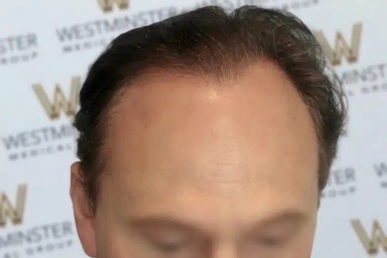 Close-up of a person's forehead and hairline, showing signs of male pattern baldness. The background features a blurred logo that includes the word "Westminster".