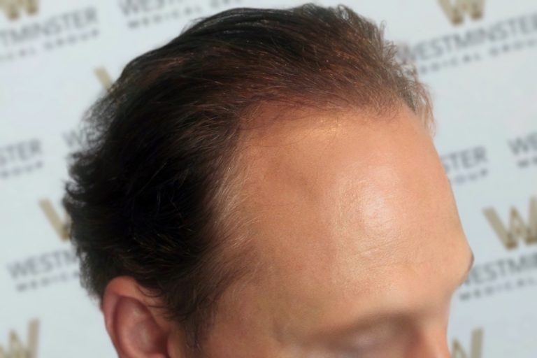 Close-up of a person's forehead and hairline, showing male pattern baldness, against a blurred background with the word "westminster" repeated.