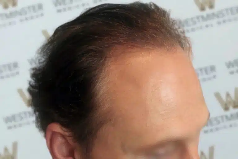 Close-up of a person's forehead and hairline, showing male pattern baldness, against a blurred background with the word "westminster" repeated.