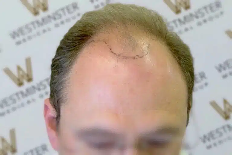 Close-up view of a man's forehead showing signs of male pattern baldness, against a blurred background with the word "westminster" repeated.