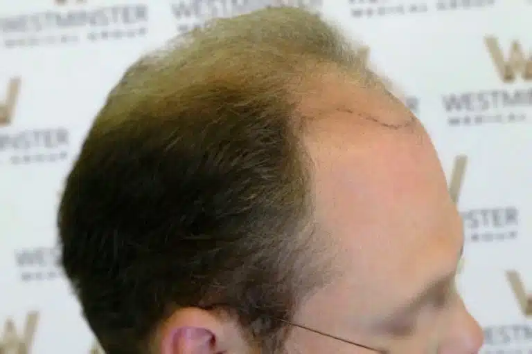 Profile view of a person showing hair implant surgery results, with visible hairline and newly growing hair on a previously bald area.