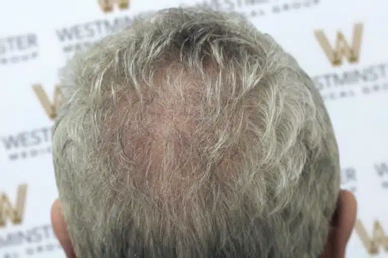 Close-up of the back of a person's head showing a bald spot with thinning grey hair, indicating female hair loss.