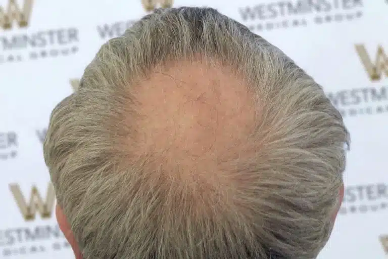 Overhead view of a person's head showing thinning gray hair with visible scalp, possibly in need of hair replacement, against a backdrop with the Westminster logo repeated.