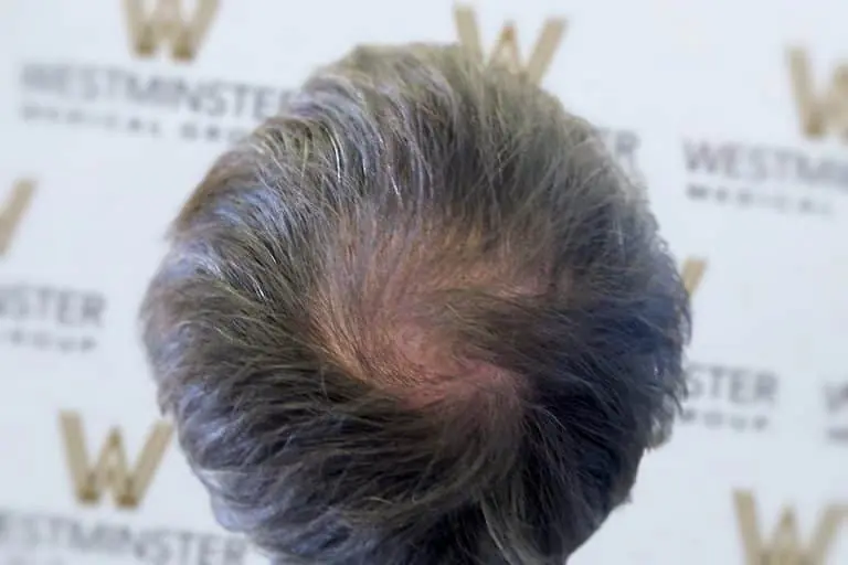 Top view of a person’s head showing thinning hair against a background of a repeated Westminster design logo, indicating the need for hair regrowth.