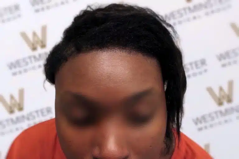 Close-up photo of a person with their eyes blurred out, showcasing their black hairstyle indicating hair regrowth against a background with 'westminster' logos.