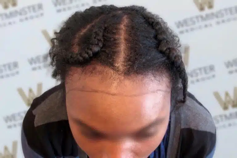 Top view of a person with intricately braided hair styled in three thick cornrows converging at the crown, addressing female hair loss. The hairstyle is showcased against a blurred background with a logo.