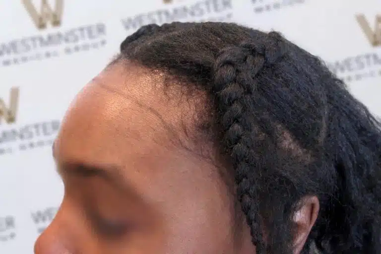 Profile view of a person with intricately braided hair against a background with the "westminster" logo repeated, highlighting themes of female hair loss.