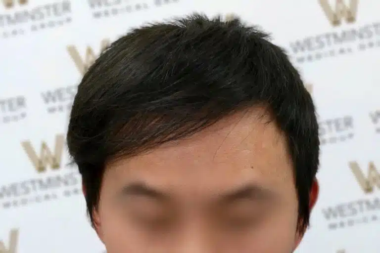 Close-up photo focused on a man's forehead and hairline demonstrating male pattern baldness, his eyes blurred out, against a backdrop with "westminster" logos.