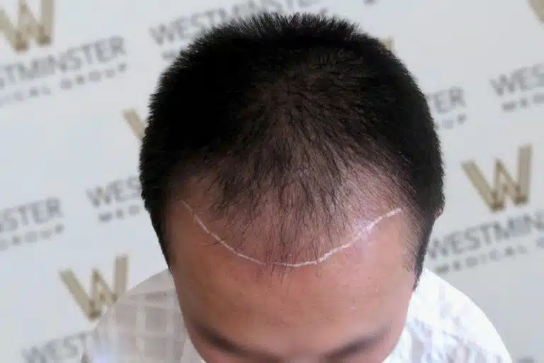 Top view of a person's head showing early stages of male pattern baldness with a visible hairline marked by a white chalk line on the scalp. Background features a logo wall with "Westminster