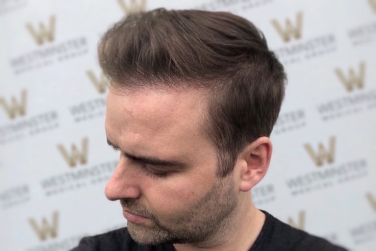 A man experiencing male pattern baldness, posing in front of a backdrop with a repeated logo, focusing on his profile view. His hair is neatly combed with a side part.