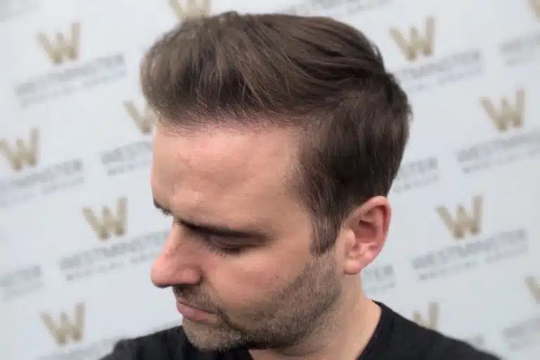 A man experiencing male pattern baldness, posing in front of a backdrop with a repeated logo, focusing on his profile view. His hair is neatly combed with a side part.