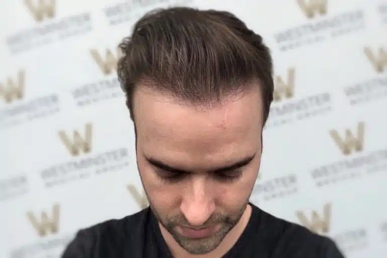 Close-up of a man's head bowed slightly, showing his combed hair after hair replacement surgery and the top part of his forehead. In the background, there is a wall with a repeating logo pattern