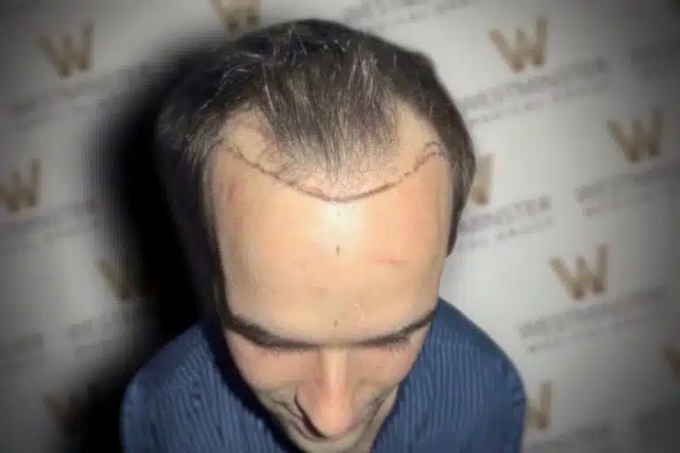 A man with a distinctive hair replacement scar visible on the back of his head, standing against a backdrop with a repeating "w" logo.