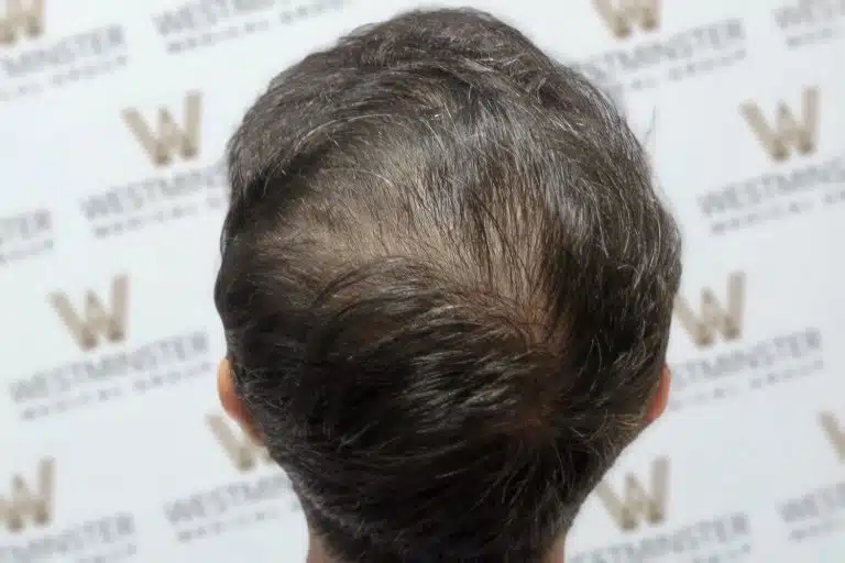 Close-up of the top of a person's head showing thick, dark hair styled to one side against a background with a repetitive 'westminster' logo, ideal for showcasing solutions for female hair loss.