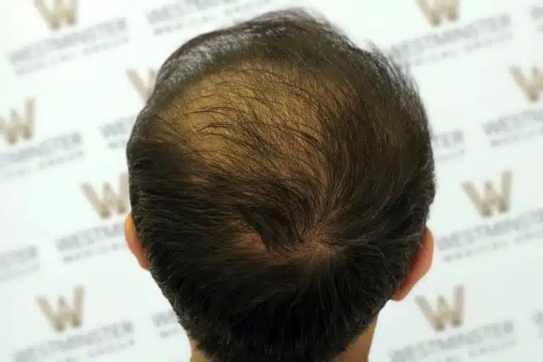 Top view of a person's head showing thinning hair and a bald spot against a background with a repeated logo pattern, indicative of female hair loss.