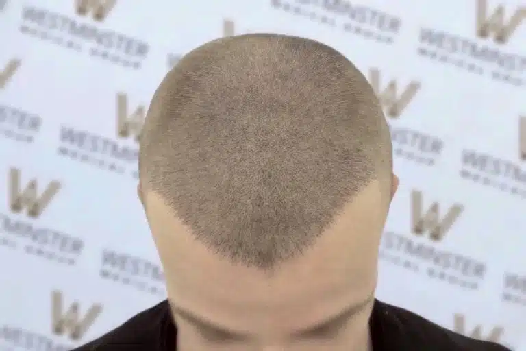 A close-up of the back of a person's shaved head with short grey hair, showing signs of female hair loss, standing against a background with a repetitive 'westminster' logo pattern.