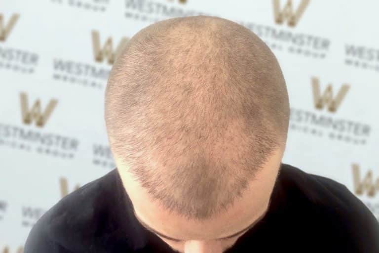 Top view of a person's head showing male pattern baldness, with a backdrop featuring the repeated logo "Westminster".