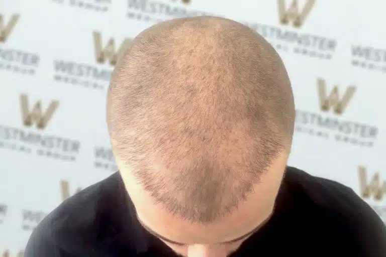 Top view of a person's head showing male pattern baldness, with a backdrop featuring the repeated logo "Westminster".
