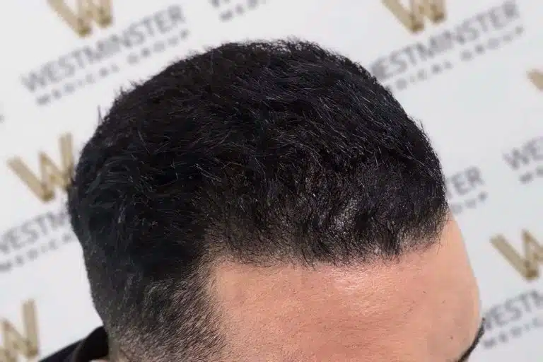 Close-up of a man's head showing signs of male pattern baldness with dark hair, against a backdrop with 'westminster' repeatedly printed.