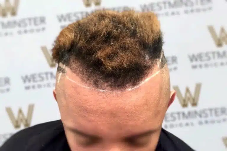Close-up of a person's unique hairstyle featuring a high fade with a carved line design, contrasted by a voluminous top with curly light brown hair implant, against a backdrop with a logo pattern.