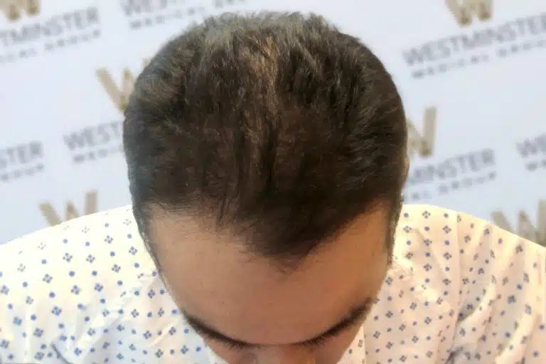 Top view of a person's head showing thinning hair and scalp, with a blurred background displaying a logo. The person is wearing a patterned shirt and considering hair replacement.