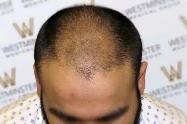 Top view of a man's head with male pattern baldness, focusing on the hair loss area, against a background with a blurred logo.