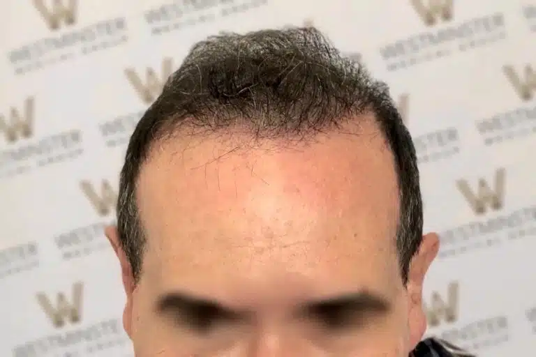 Close-up photo of a man with a receding hairline, focusing on the forehead and hair replacement. Background blurred, with visible "Westminster" logos.
