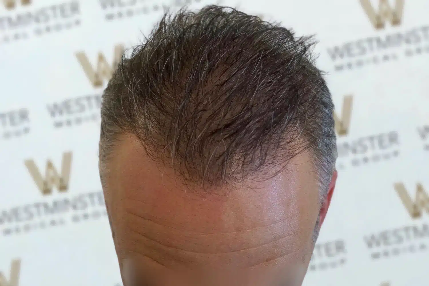 Close-up image of the top of a person's head showing textured dark hair against a backdrop with a repeating "Westminster" logo pattern. The focus is on the detailed hair texture, showcasing signs of