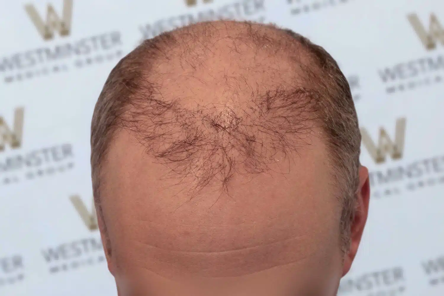 Top view of a man's head showing early stages of male pattern baldness with visible thinning hair and scalp on a background with the "westminster" logo.