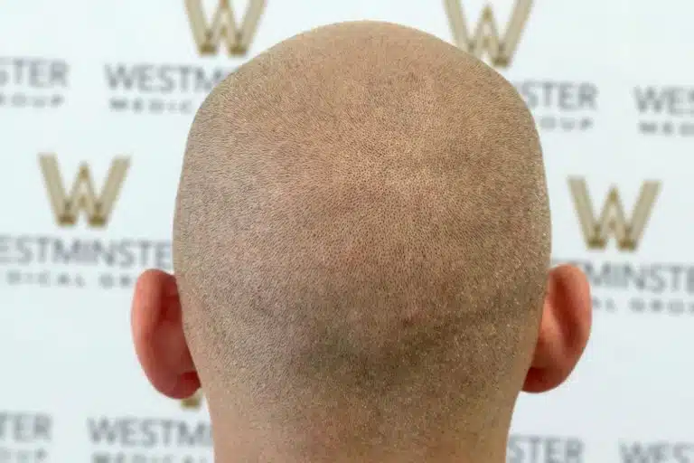 Back view of a person's shaved head showing signs of male pattern baldness against a background with multiple "westminster" logos.
