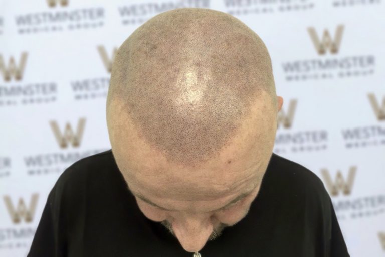 Top-down view of a bald person's head with visible hair follicles, indicative of male pattern baldness, standing against a background with the repeated logo "Westminster.