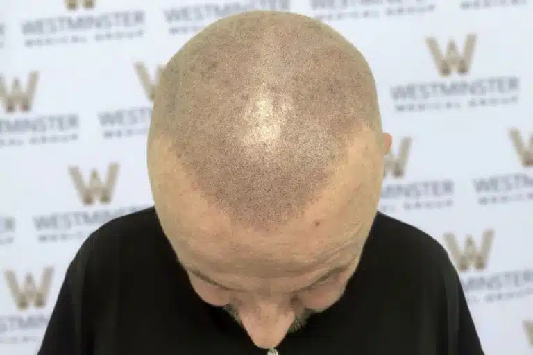 Top-down view of a bald person's head with visible hair follicles, indicative of male pattern baldness, standing against a background with the repeated logo "Westminster.