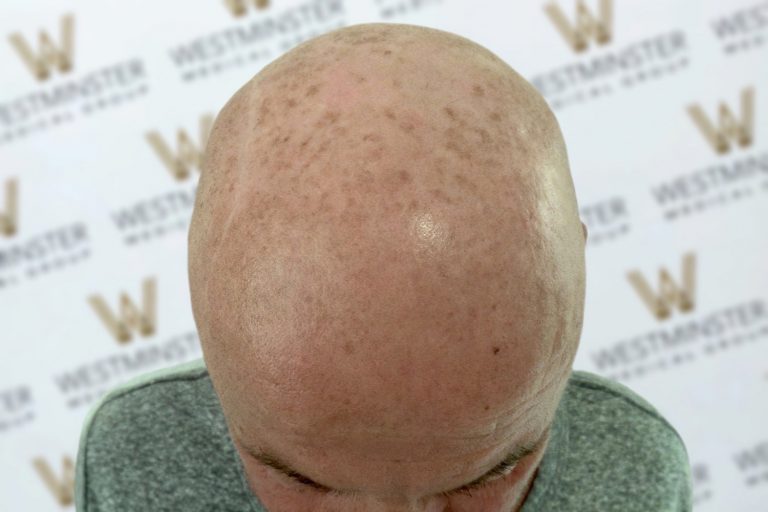 Top view of a bald person's head showing the scalp and a partial view of ears against a backdrop with the Westminster logo, depicting female hair loss.