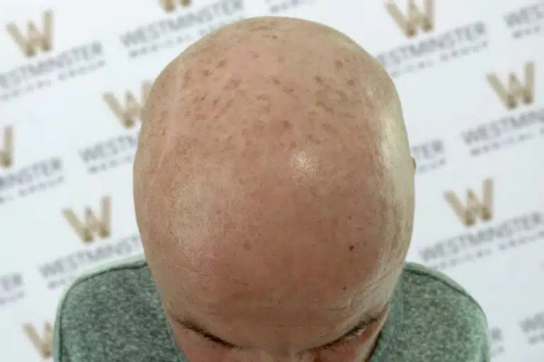 Top view of a bald person's head showing the scalp and a partial view of ears against a backdrop with the Westminster logo, depicting female hair loss.