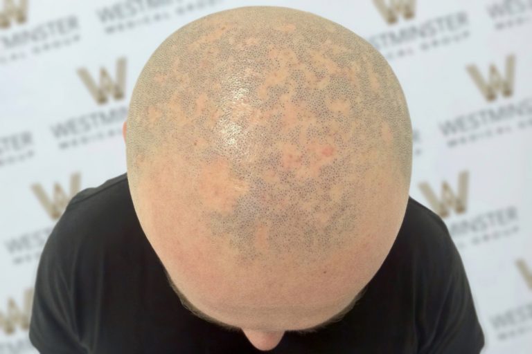 Top view of a male pattern baldness showing visible pores and skin texture, against a background with a logo pattern.