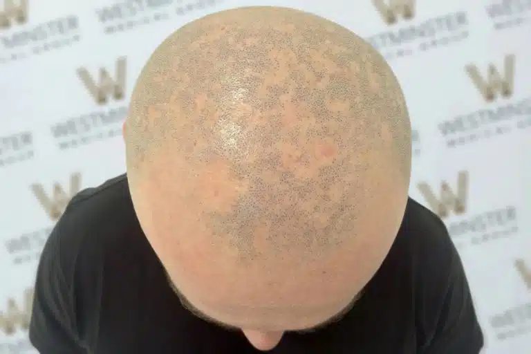 Top view of a male pattern baldness showing visible pores and skin texture, against a background with a logo pattern.